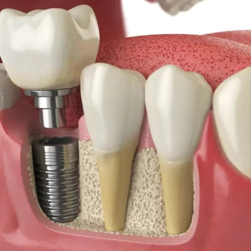 What Is The Fastest Way To Whiten Your Teeth?
